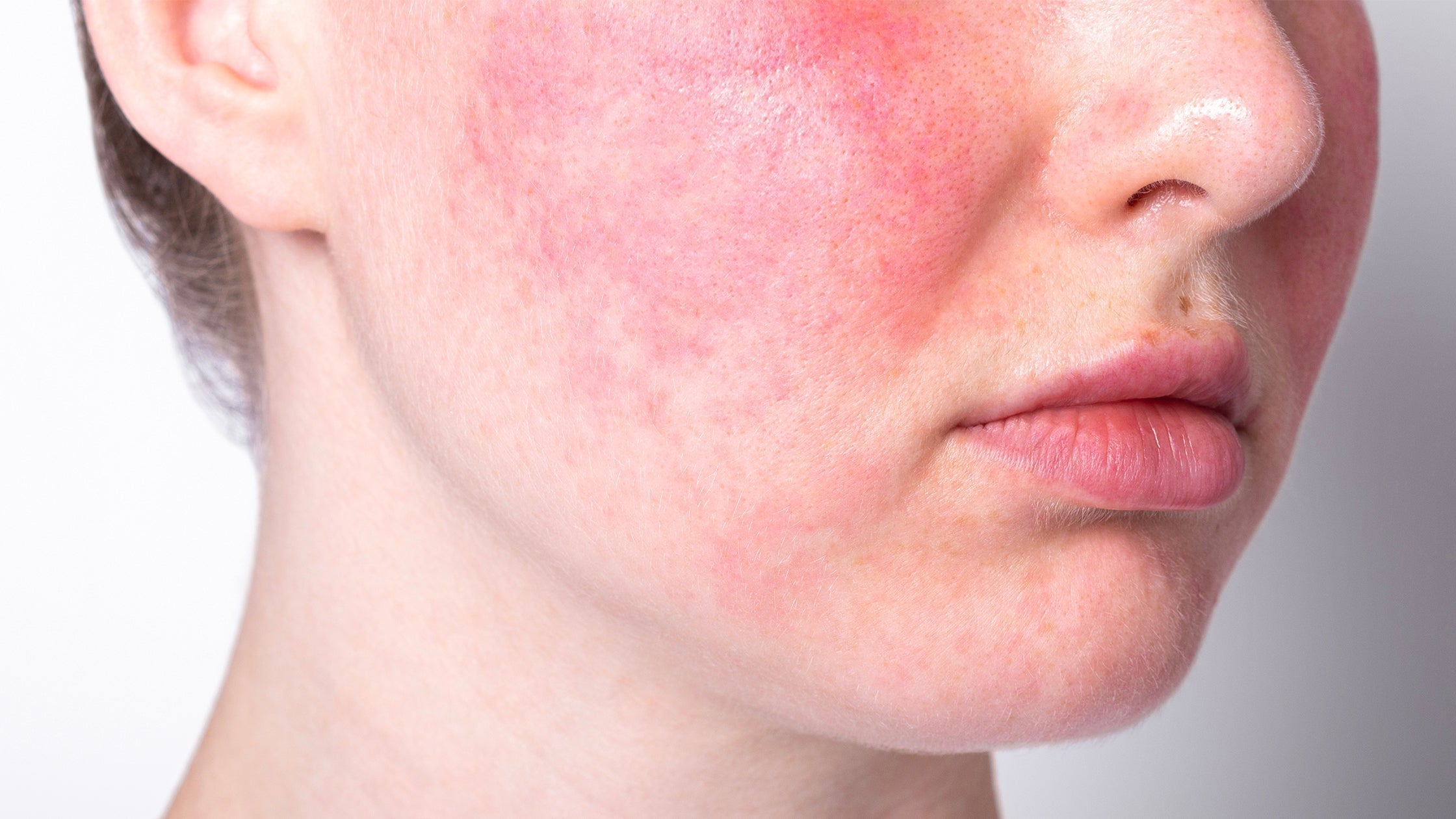 glutathione and rosacea How to alleviate symptoms of Rosacea? – OSKIA