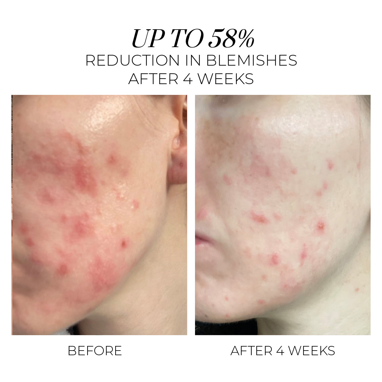Clinical Trial Results - up to 58% reduction in blemishes after 4 weeks of using the entire Violet Water Range.