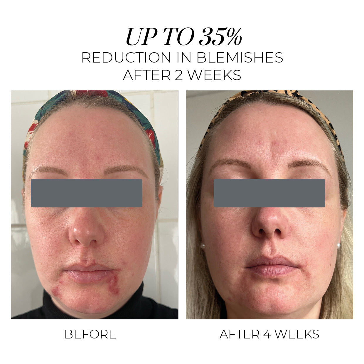 Clinical Trial Results up to 35% reduction in blemishes after 2 weeks.
