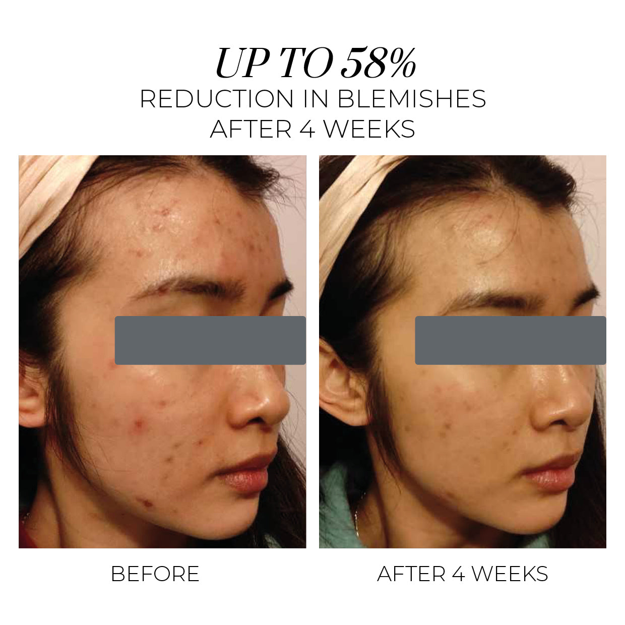 Violet Water Clinical Trial Results. Up to 58% reduction in blemishes after 4 weeks.