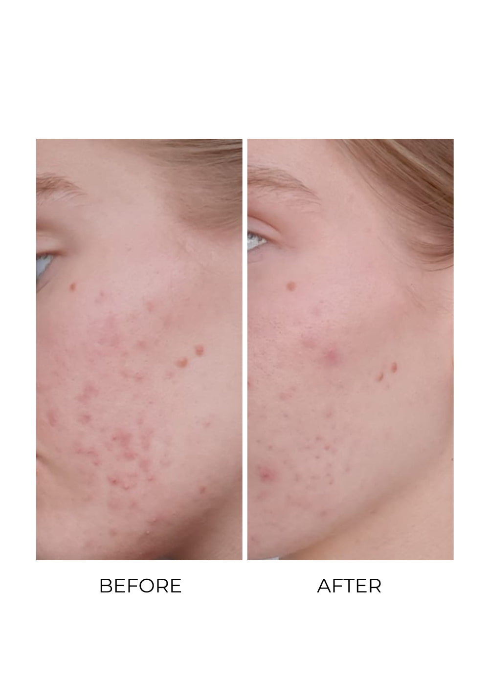 MSM for acne: the science behind why it works