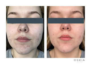 Best product for acne prone skin - Marie Clare Awards. Before and After photo Acne skin showing a dramatic improvement